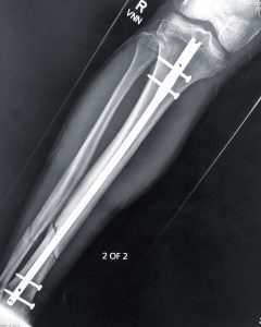 Leg x-ray